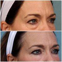 Liquid Facelift With Botox
