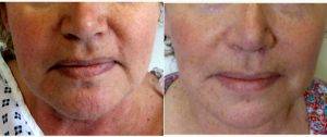 Lower Face And Neck Lift Before And After With Doctor William Townley, MD, FRCS(Plast), London Plastic Surgeon