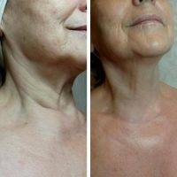 Lower Face Neck Lift Surgery Before And After
