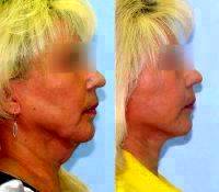 Lower SMAS Facelift Before And After