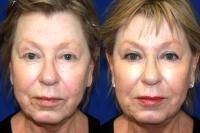 Lunch Hour Facelift Before And After Photos