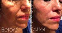 Lunch Hour Facelift Image