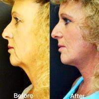 MACS Facelift Technique Before And After