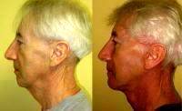 Male Endoscopic Facelift Before And After