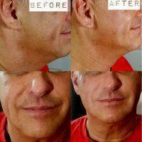 Male Liquid Facelift Before And After