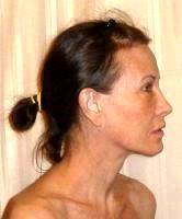 Mini Facelift Can Be Performed On An Outpatient Basis