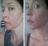 New Facelift Patient Result With Doctor Douglas K. Henstrom