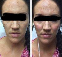 Non Invasive Facelift In Tijuana Before And After
