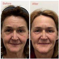 One Month After Non-surgical Face Rejuvenation With Laser Resurfacing Around The Eyes And PRP On The Forehead