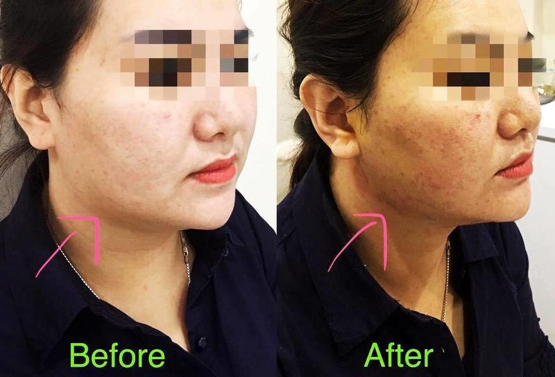 One Stitch Facelift Before And After Photos (8) » Facelift: Info ...