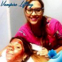 PRP Vampire Facelift Before And After (11)