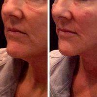 PRP Vampire Facelift Before And After (13)