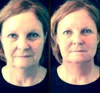 PRP Vampire Facelift Before And After (14)