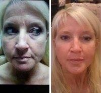 PRP Vampire Facelift Before And After (4)