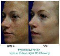 Photorejuvenation Before And After