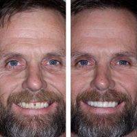 Properly Fitting Dentures Should Give You The Confidence You Had With Your Natural Smile