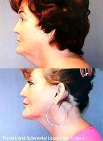 Real Facelift Results Will Last For Years