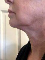 Remove Jowls And Double Chin