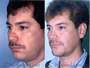 Rhinoplasty, Face And Neck Liposuction, Chin Correction By Doctor Andrew T. Lyos, MD, FACS, Houston Plastic Surgeon