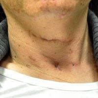 Scar After Neck Lift