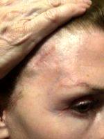 Scar Photo After Endoscopic Facelift Be Doctor Mark A. Doyle