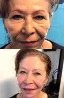 The Vampire Facelift Before And After (2)