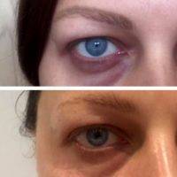 Thermage Before And After Eyes (2)