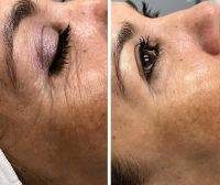 Thermage Before And After Eyes (3)