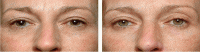 Thermage Before And After Eyes Photos)