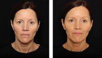 Thermage Before And After Photos Face (12)