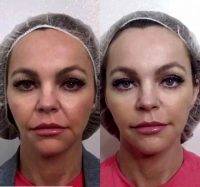 Thermage Before And After Photos Face (15)