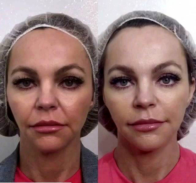 Thermage Before And After Photos Face 15 Facelift Info Prices