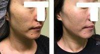 Thermage Before And After Photos Face (3)