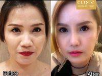 Thermage Before And After Photos Face (4)