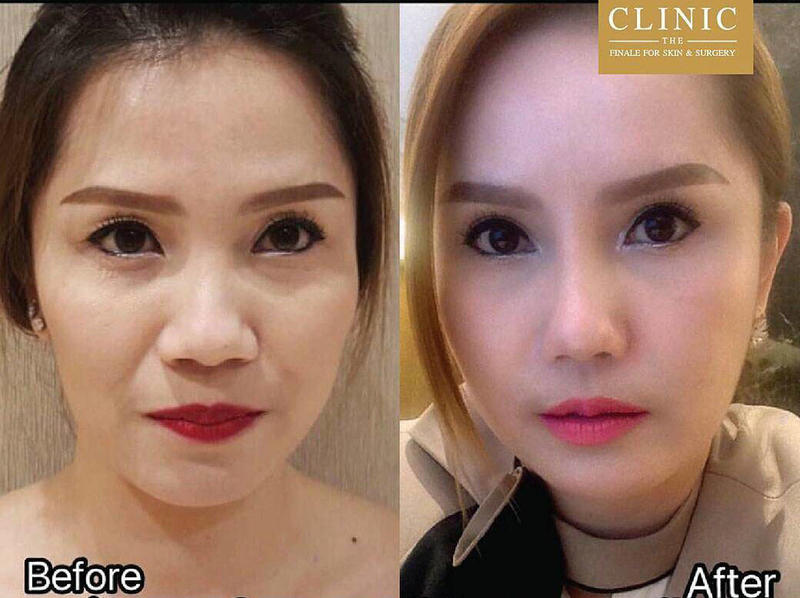 Thermage Before And After Photos Face 4 Facelift Info Prices