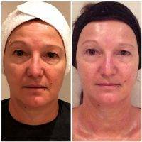 Thermage Before And After Photos Face (5)