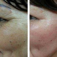Thermage Before And After Photos Face (6)
