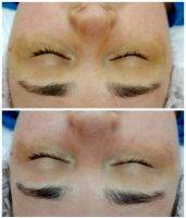 Thermage Cpt Before And After Photos (2)