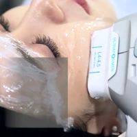 Thermage Cpt Face Procedure