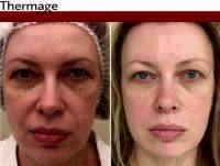Thermage Facelift Before After