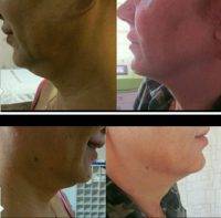 Thermage For Neck Before And After (2)