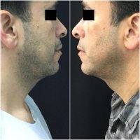 Thermage For Neck Before And After (3)