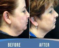 Thermage For Neck Before And After (5)