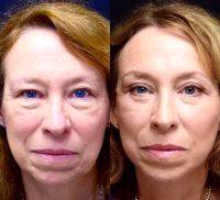 Traditional Facelift Before And After