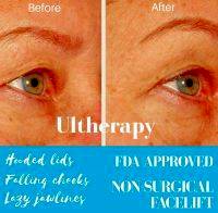 Ultherapy Nonsurgical Facelift