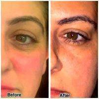 Ultherapy Treatment To Under The Eyes