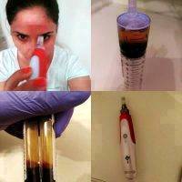 Use Your Blood To Rejuvenate Your Face