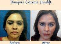 Vampire Facelift Before And After (1)