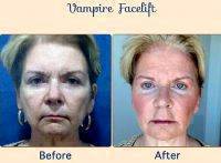 Vampire Facelift Before And After (2)
