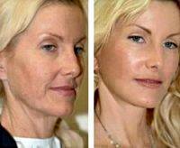 Vampire Facelift Before And After (6)